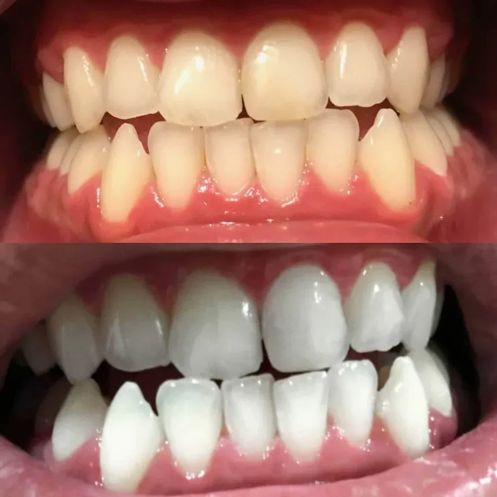 ShinySmile™ — Instantly Whiten & Boost Confidence | 1+1 FREE
