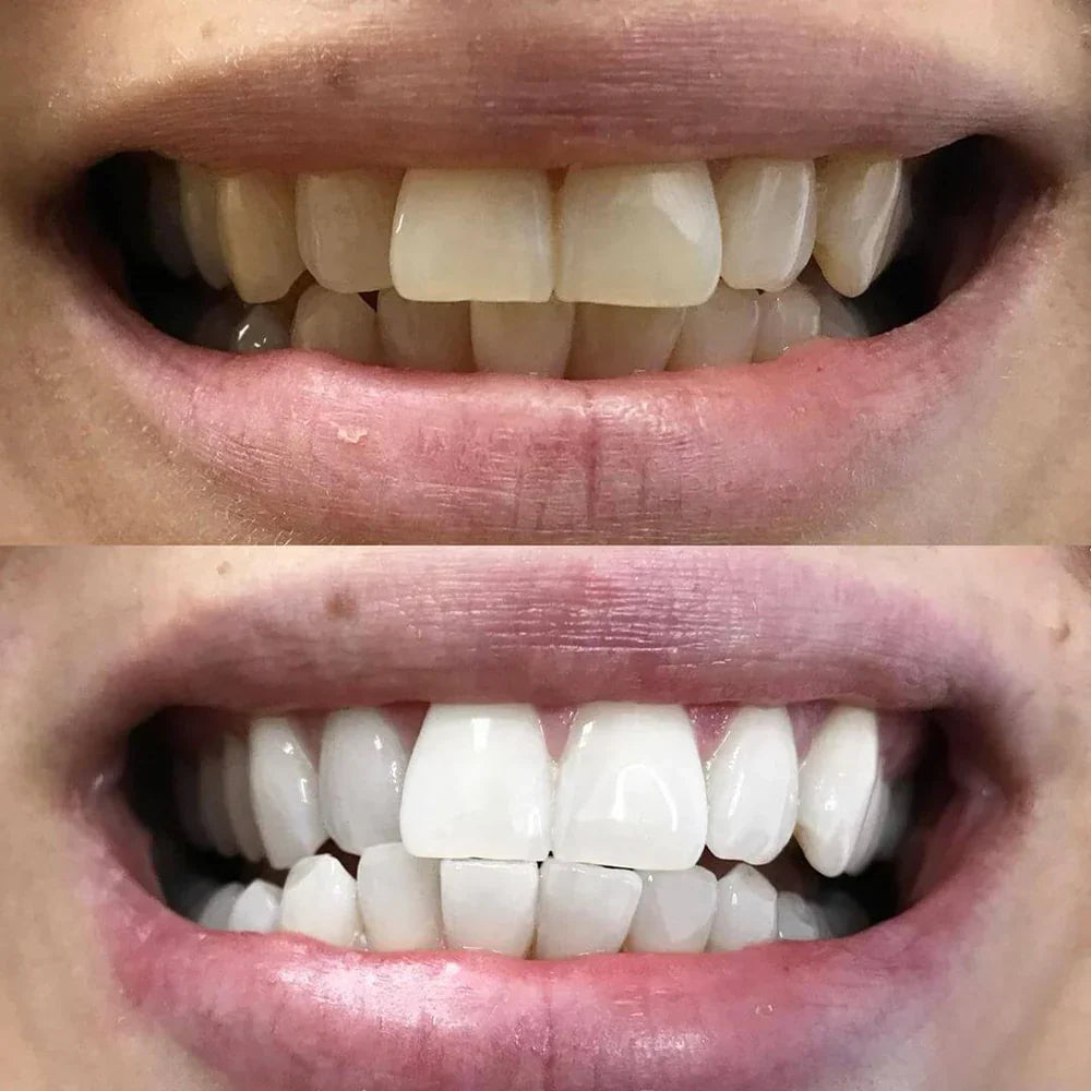ShinySmile™ — Instantly Whiten & Boost Confidence | 1+1 FREE