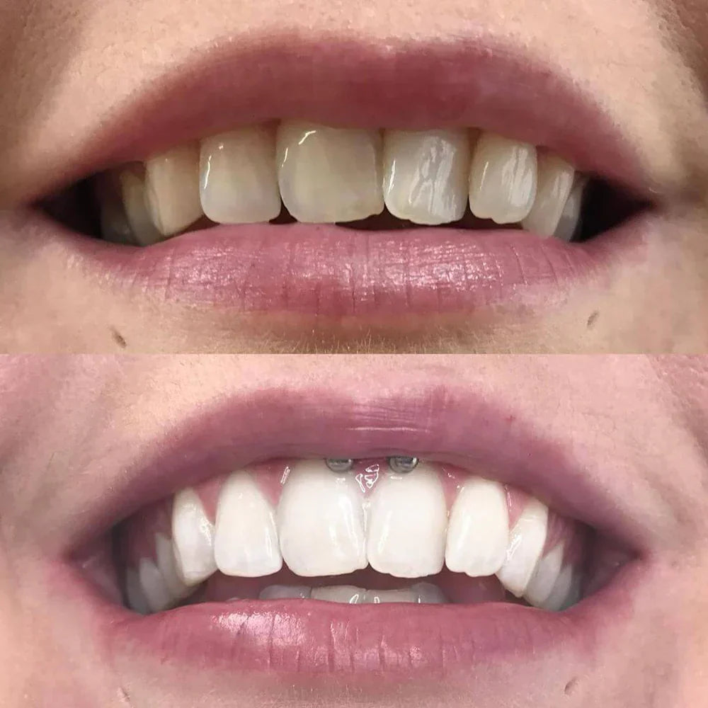 ShinySmile™ — Instantly Whiten & Boost Confidence | 1+1 FREE